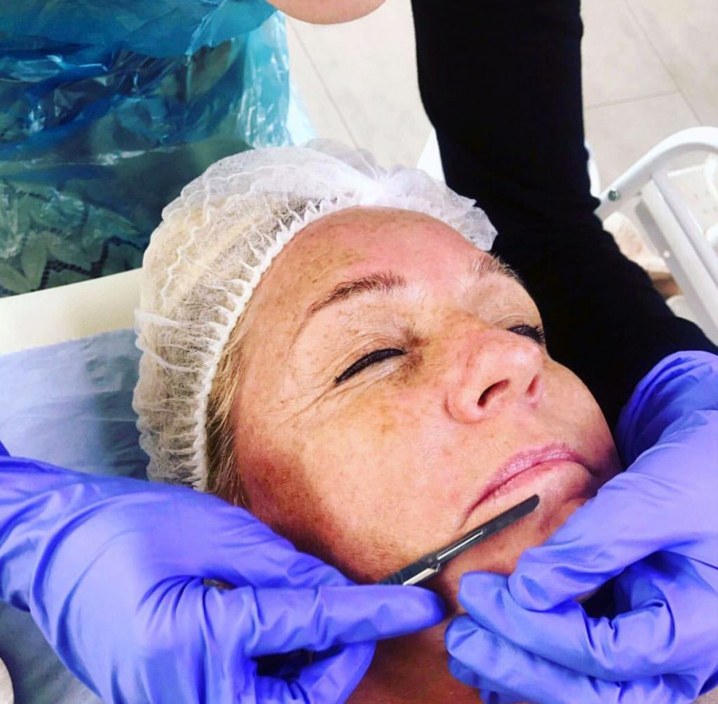 Dermaplaning close up